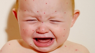 Alertă! Focar de rujeolă: vaccinați copiii!