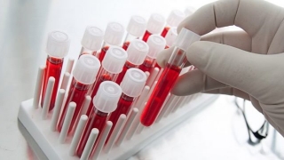 Un test de sânge care detectează cancerul ovarian a obținut rezultate pozitive în teste