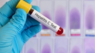 Bolnavii de hepatită C, şanse de 98 - 99% pentru vindecare