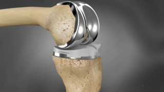 Sunt eficiente intervențiile chirurgicale în cazul afecțiunilor degenerative ale genunchiului?