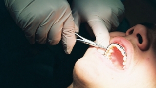 Dentist din Rusia, acuzat că i-a extras unei femei „22 de dinți sănătoși“