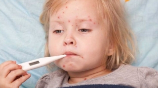 Focar de varicelă într-o grădiniță din Constanța