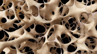 Ziua Mondială a Osteoporozei - prevenire, diagnoză şi tratament