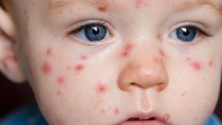 Îmbolnăviri pe bandă rulantă! 23 de copii cu rujeolă, toți nevaccinați